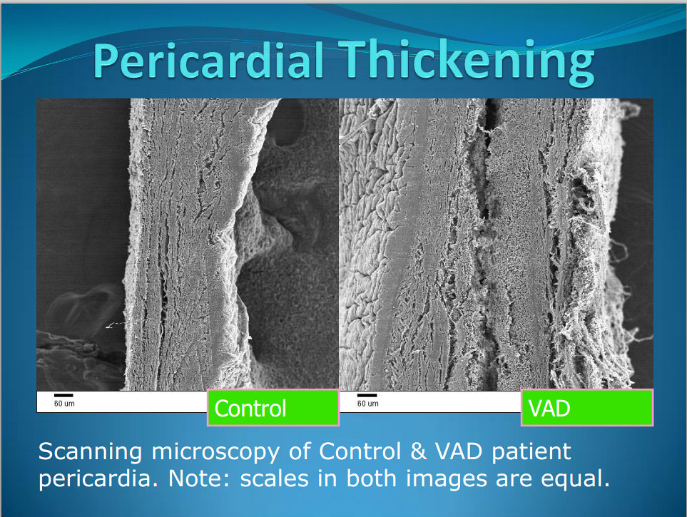 pericardial thickening